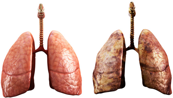 Healthy vs Unhealthy Lungs.